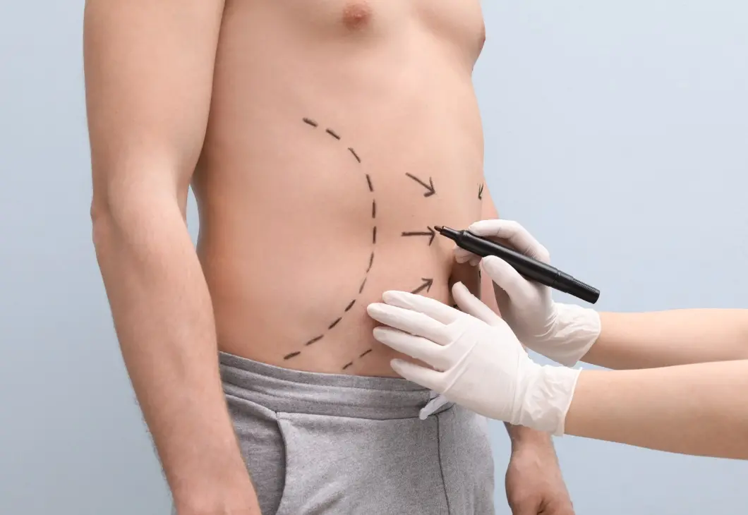 Imagem da notícia: Lipoaspiração: como é feita, custos e riscos ao paciente 