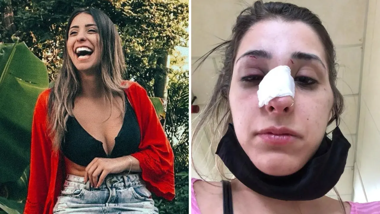 Imagem da notícia: Modelo é agredida por ex-namorado um dia após terminar relacionamento e fica com nariz 'deformado'