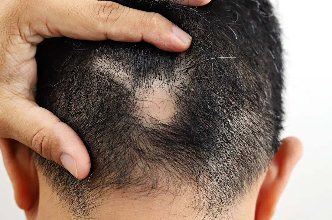 Imagem da notícia: Alopecia: sintomas, prevenção e tratamento