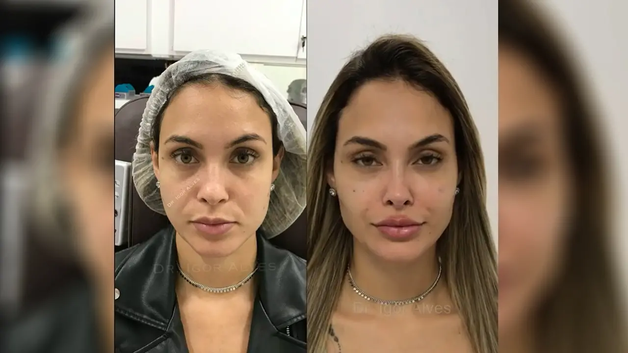 Imagem da notícia: Sarah do BBB 21 faz harmonização facial entre outros procedimentos estéticos 