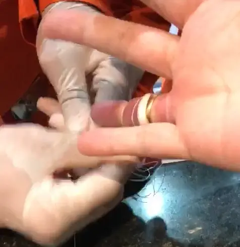 Imagem da notícia: Corpo de Bombeiros usa fio dental para retirar anel preso em dedo de mulher em Fortaleza