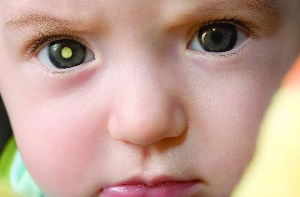 Imagem da notícia: Retinoblastoma: o que é e quais são os sintomas do câncer diagnosticado na filha de Tiago Leifert