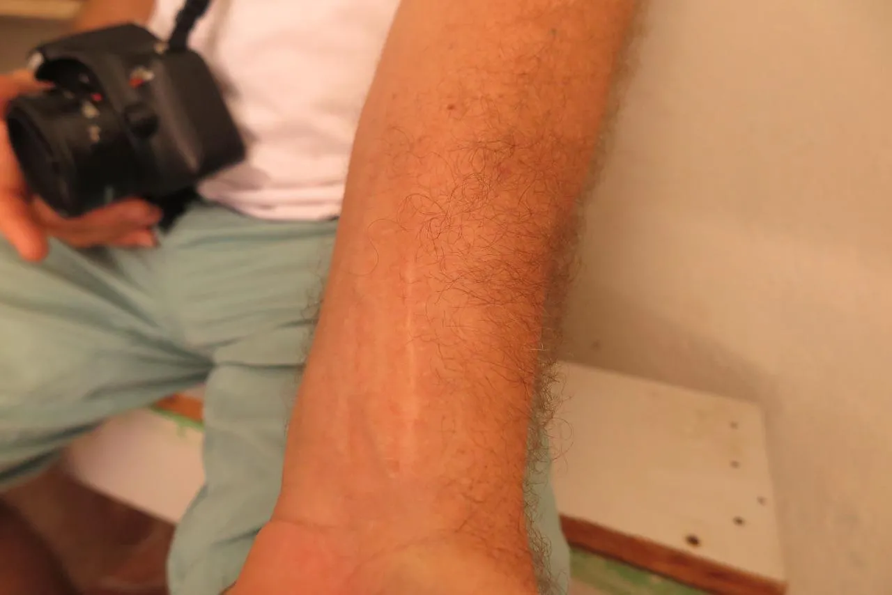Cicatriz não foi explicada, mas o homem não precisou passar por amputação
