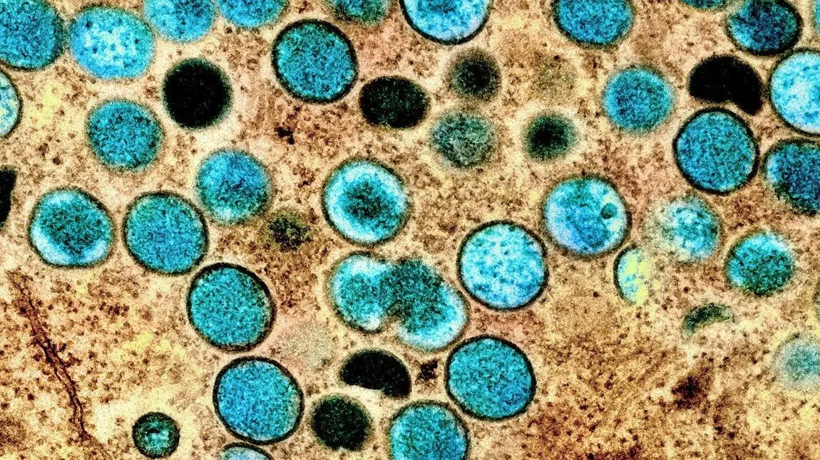 Imagem da notícia: Dois novos casos suspeitos de varíola dos macacos são notificados no Ceará, diz Sesa