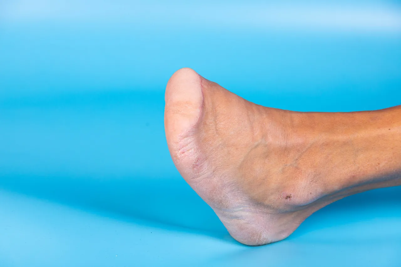 Cuidado com índices como glicemia e colesterol podem evitar o agravamento que leva à necessidade de amputação
