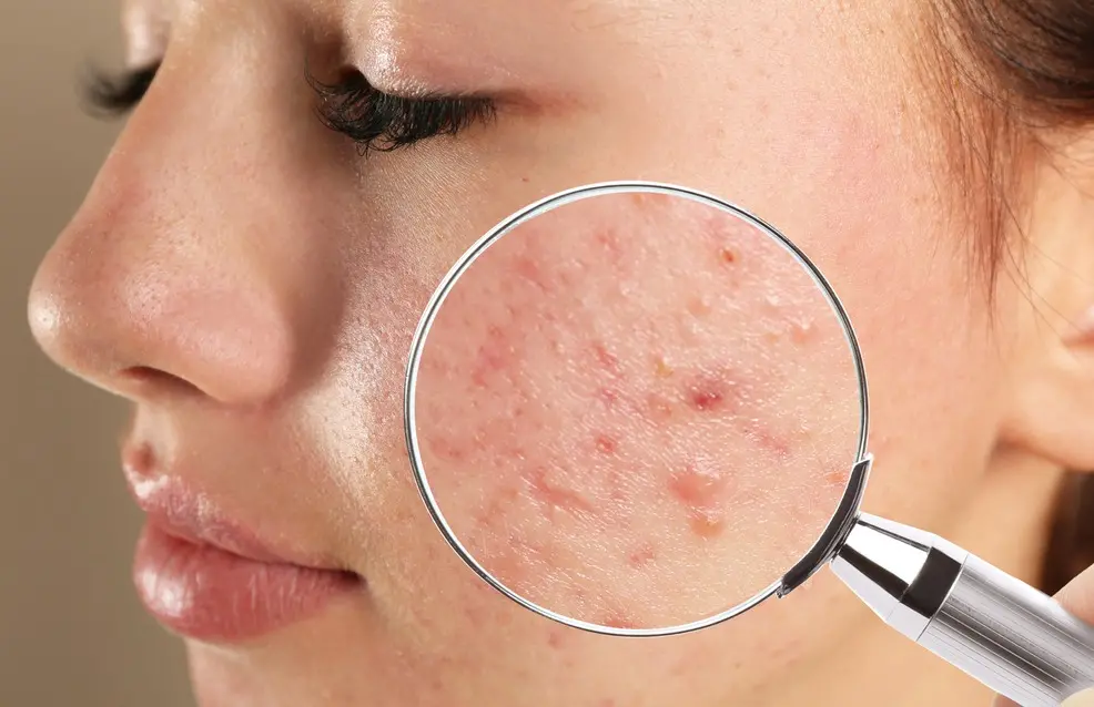 Pele com acne. Uma lupa está por cima.