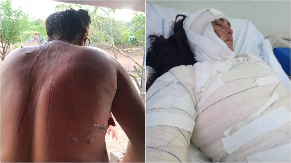 Imagem da notícia: Homem é preso em flagrante ao jogar ácido em corpo de mulher após brigar com marido dela 