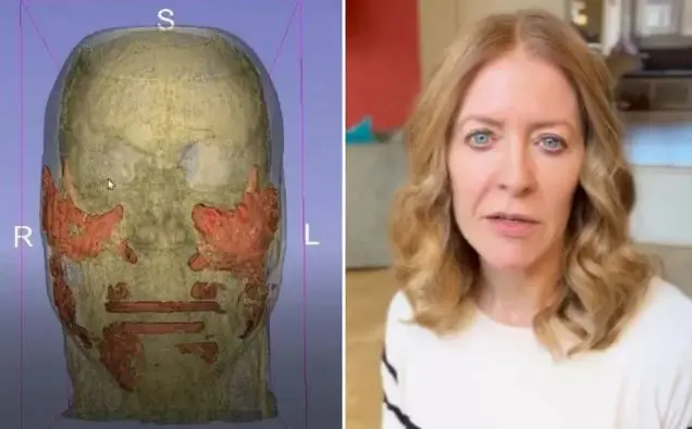 Imagem da notícia: Jornalista revela que ácido hialurônico, usado na harmonização facial, ficou em seu rosto por 4 anos