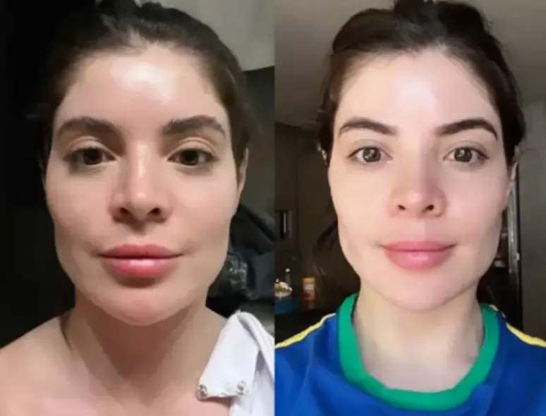Gkay é outra personalidade que optou por reverter a harmonização facial