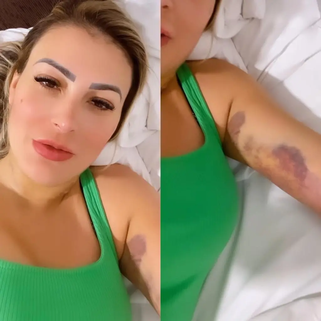 Imagem da notícia: Andressa Urach mostra marcas roxas após lipoaspiração: 'a dor passa, e a beleza fica'