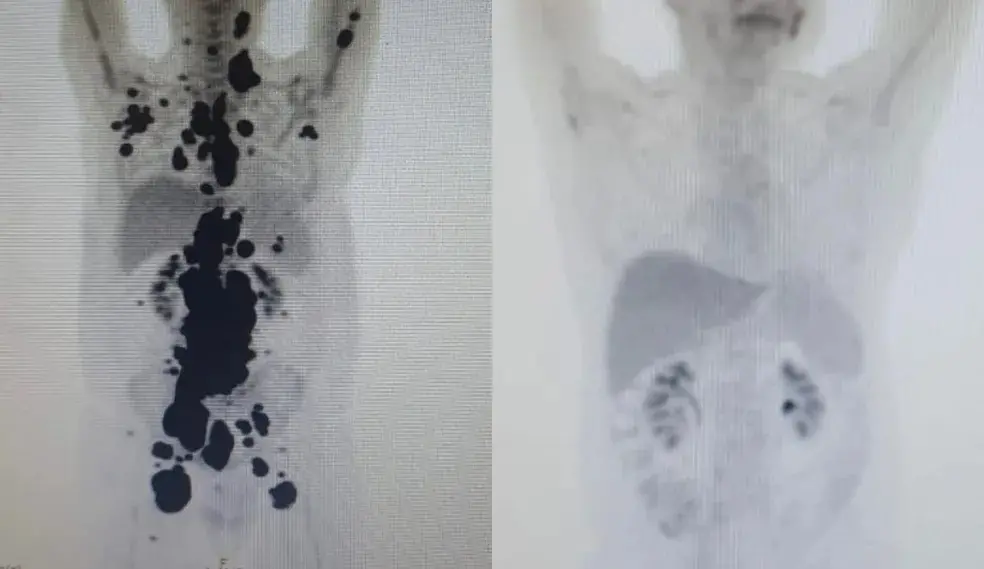 Exames que mostram antes e depois de paciente com câncer e sem câncer