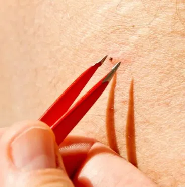 Se encontrar um carrapato fixado em seu corpo, a recomendação é removê-lo com uma pinça