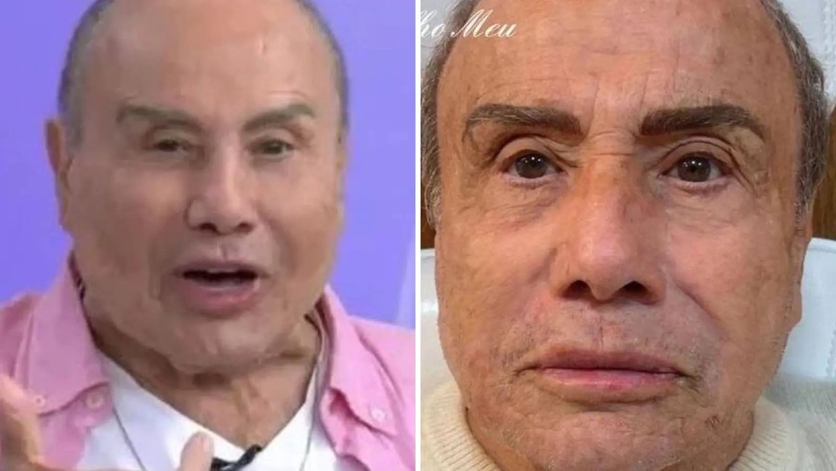 Imagem da notícia: Cirurgiã da harmonização de Stênio Garcia diz que houve distorção na TV: 'colocaram tanta luz'