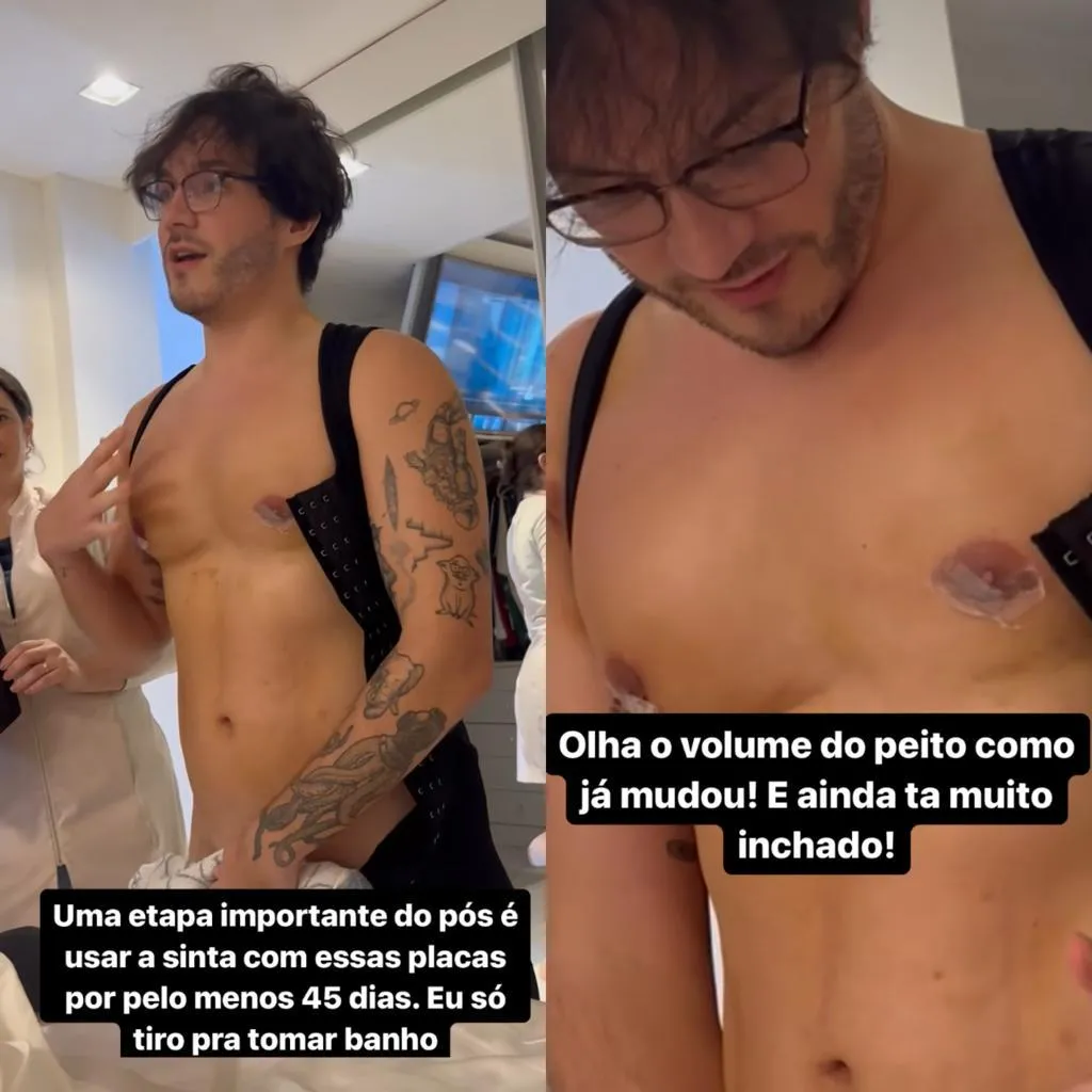 Eliezer pós cirurgia para reduzir mama