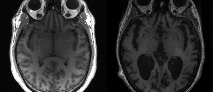 Imagem da notícia: Cientistas revelam como Alzheimer supostamente 'mata' neurônios: 'descoberta é emocionante'