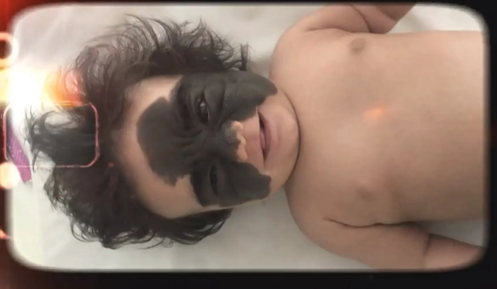Imagem da notícia: Conheça Luna, menina brasileira que nasceu com 'nevo' no rosto e já passou por 6 cirurgias