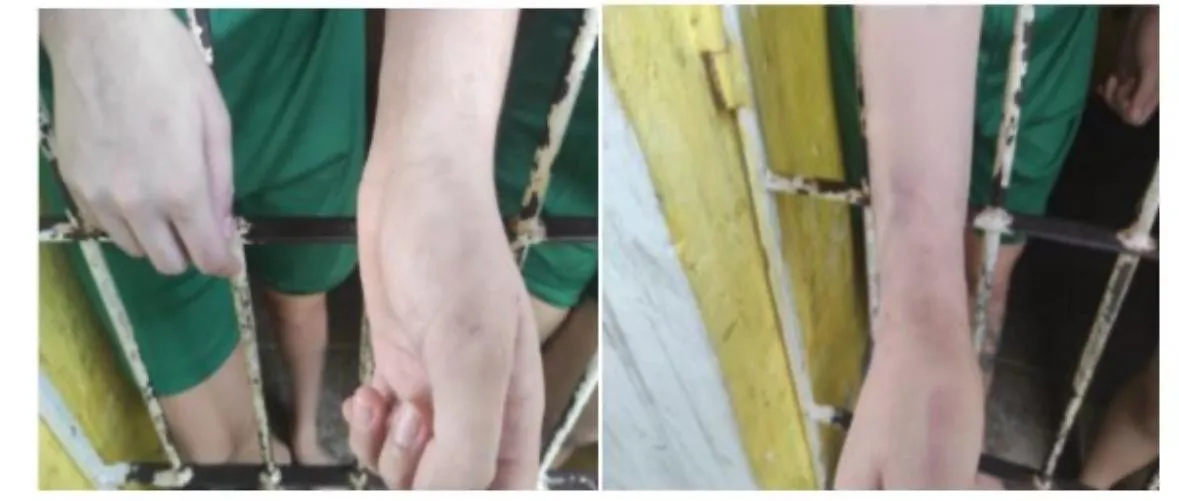 Hematomas supostamente causados por situações de maus tratos, como denunciaram as internas durante visita das entidades de defesa de direitos humanos