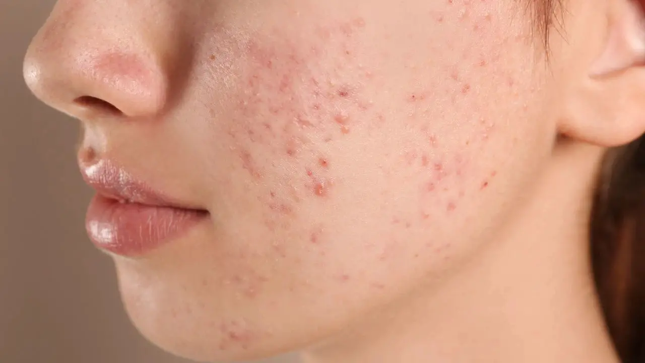 pele com acne