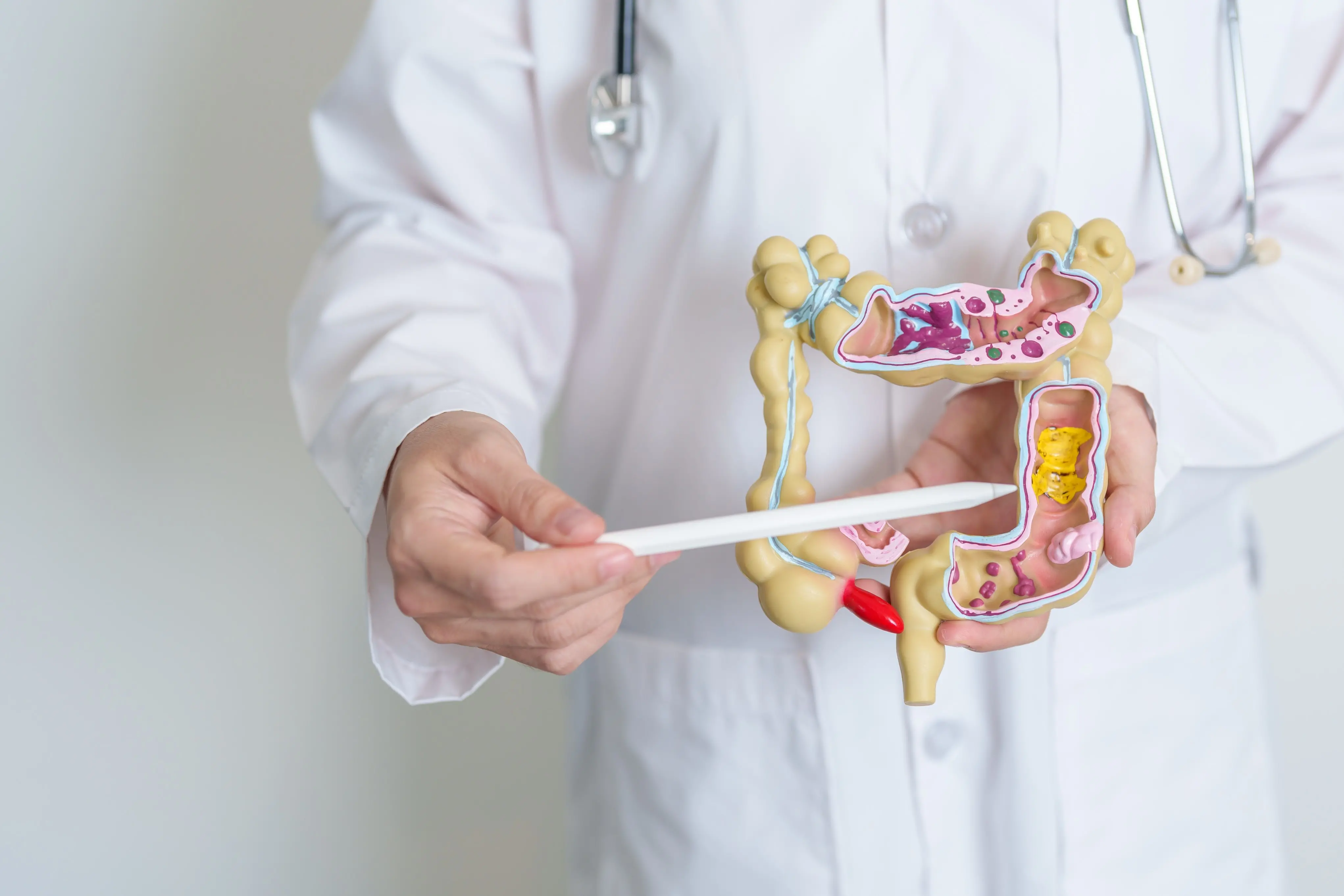 Imagem de um médico segurando o modelo de um intestino, local onde a doença age