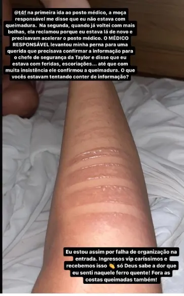 Imagem da notícia: Fã de Taylor Swift mostra fotos de queimaduras na perna e revela: ‘Tinha gente vomitando, desmaiando