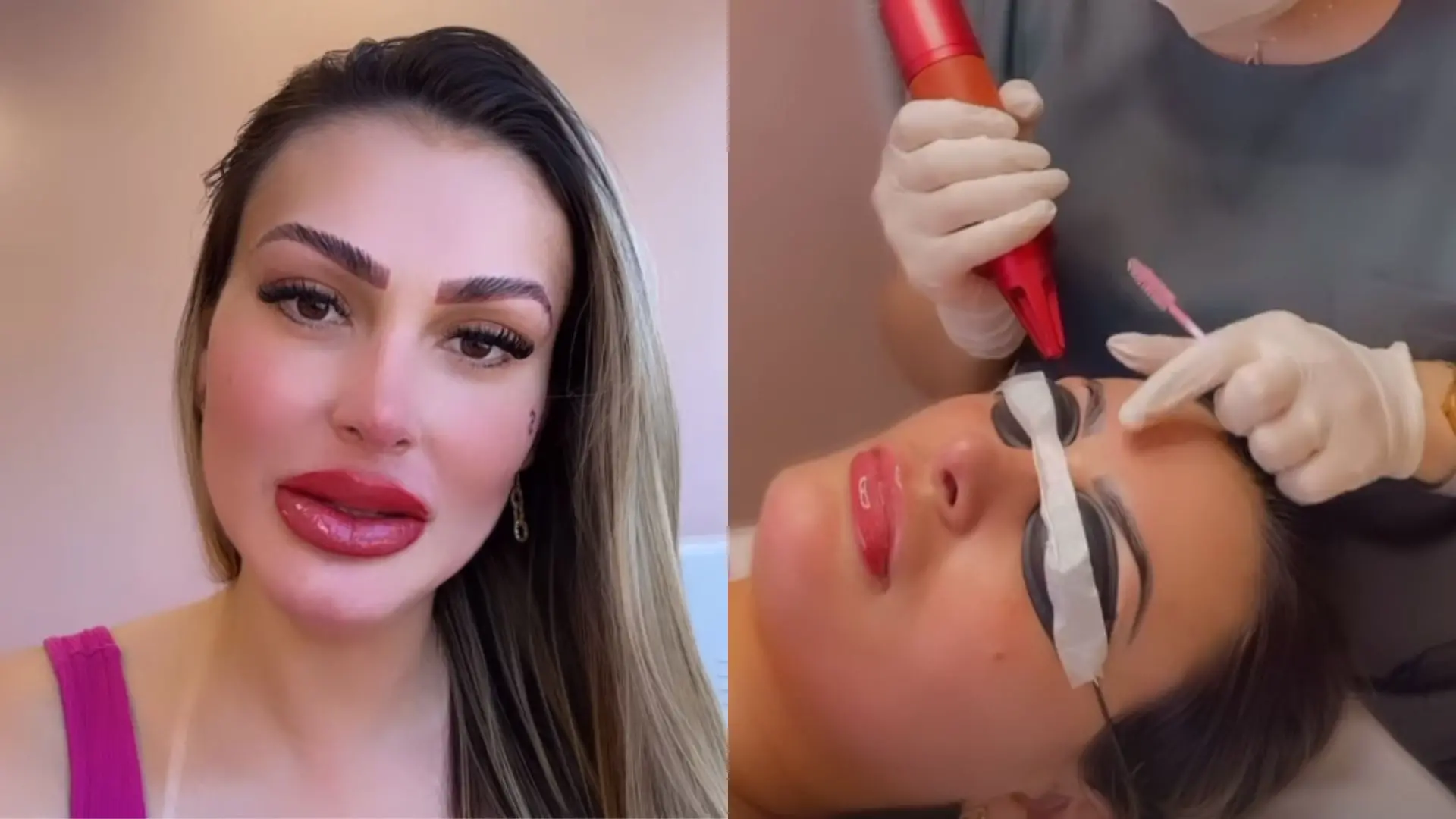 Imagem da notícia: Andressa Urach faz procedimento estético na boca para ficar com 'efeito batom'