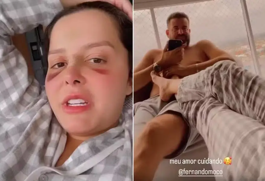 Imagem da notícia: Maraísa mostra hematomas no rosto e cuidados do noivo