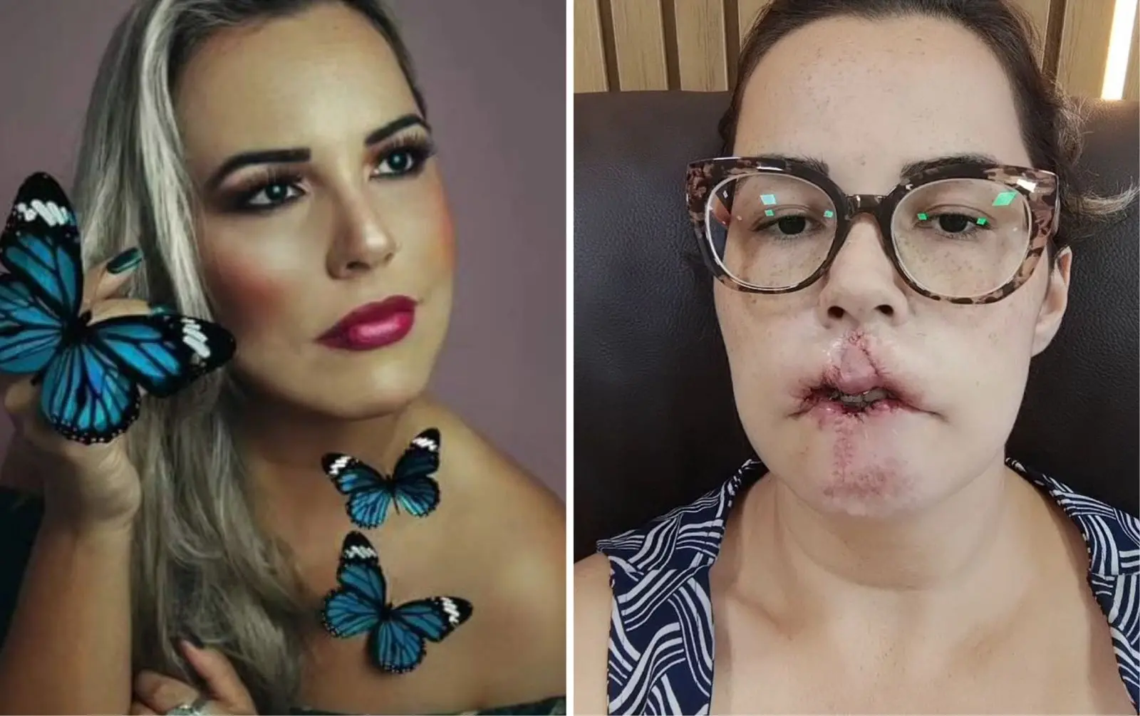 Imagem da notícia: Mulher perde lábio superior após realizar preenchimento labial e harmonização com PMMA