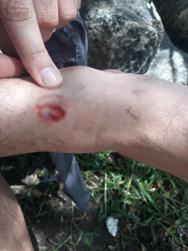 Parte das pessoas feridas não buscam atendimento médico