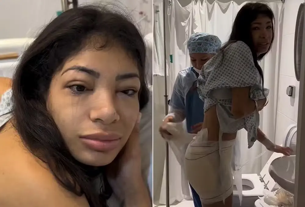 Imagem da notícia: MC Princesa relata rotina de retirada de PMMA dos glúteos após quinta cirurgia: 'Sofrimento'