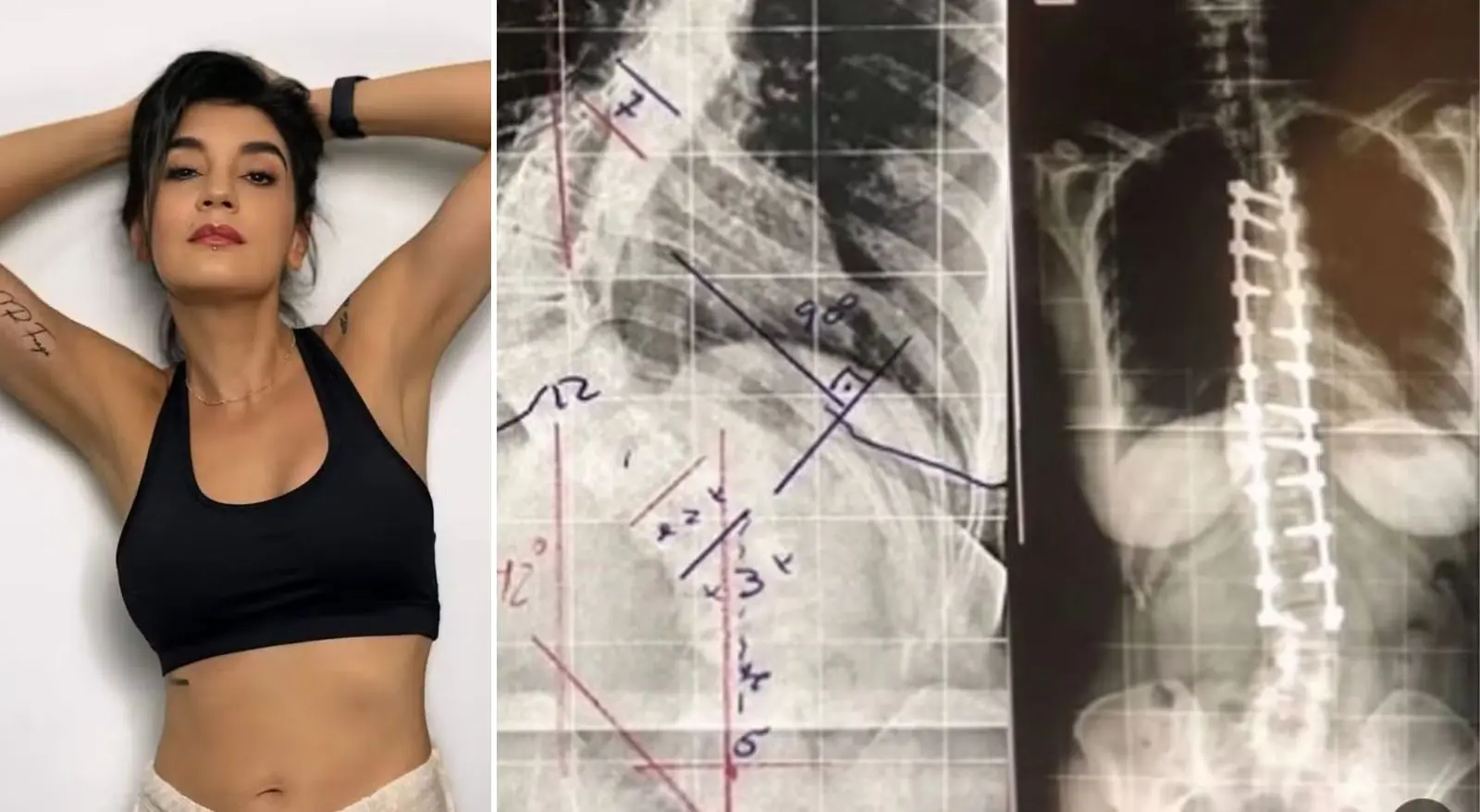 Imagem da notícia: Atriz relembra cirurgia para reparar escoliose de 90 graus: 'Meu cérebro não entende até hoje'
