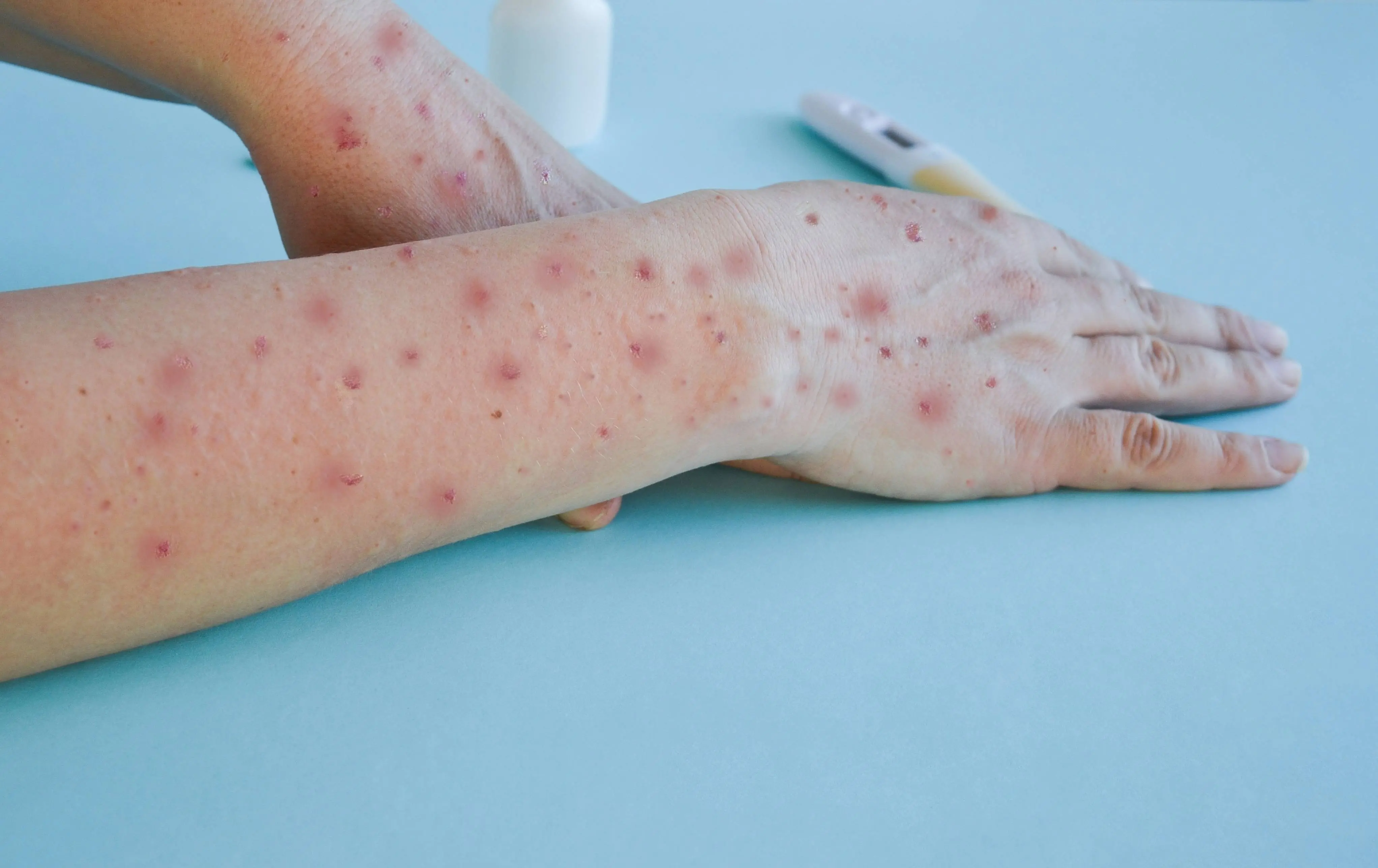 Imagem da notícia: Saiba como é a transmissão da doença mpox e como se prevenir