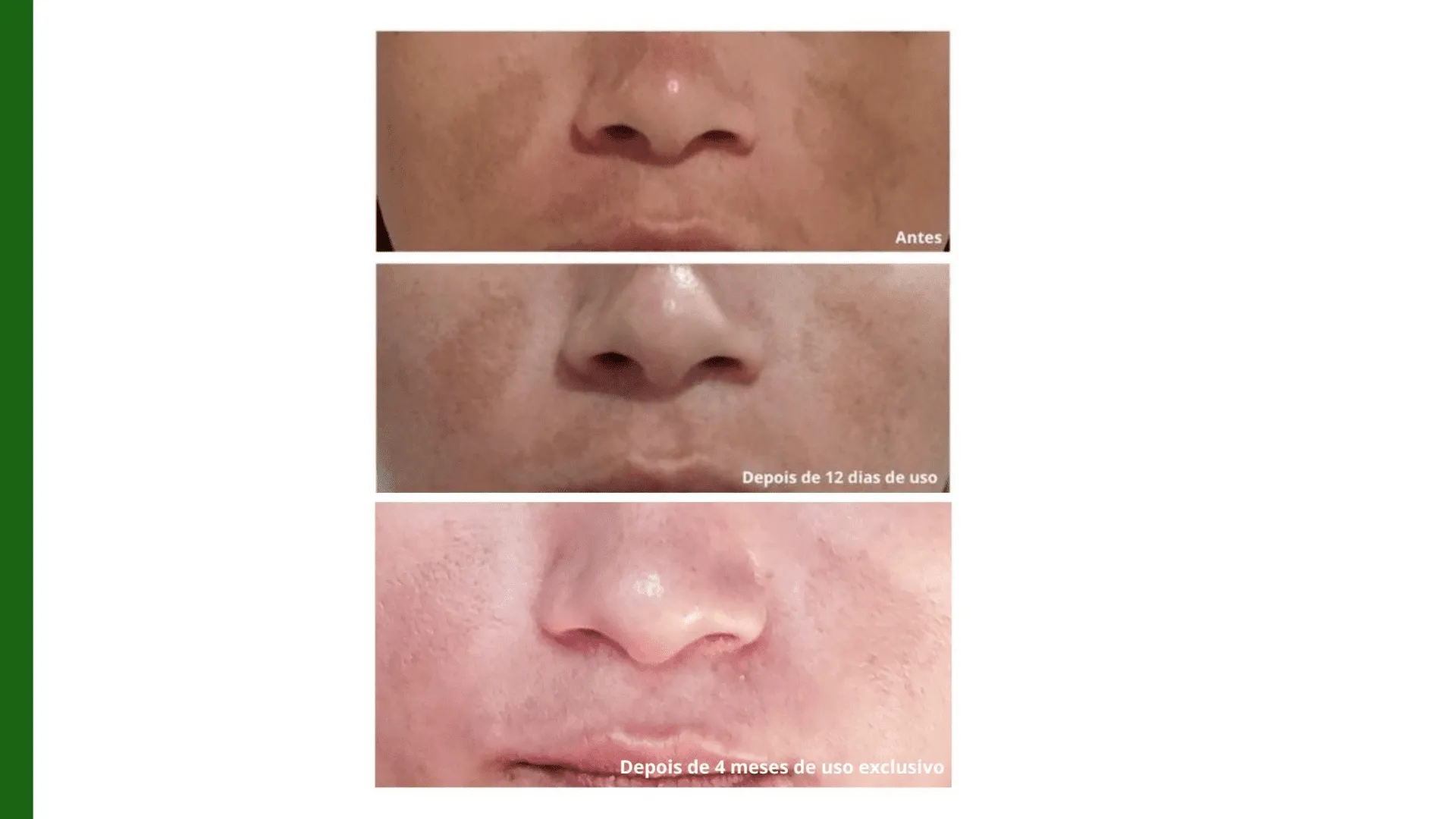 A pesquisa mostrou resultados positivos no clareamento de melasma com resultados em pouco tempo de uso