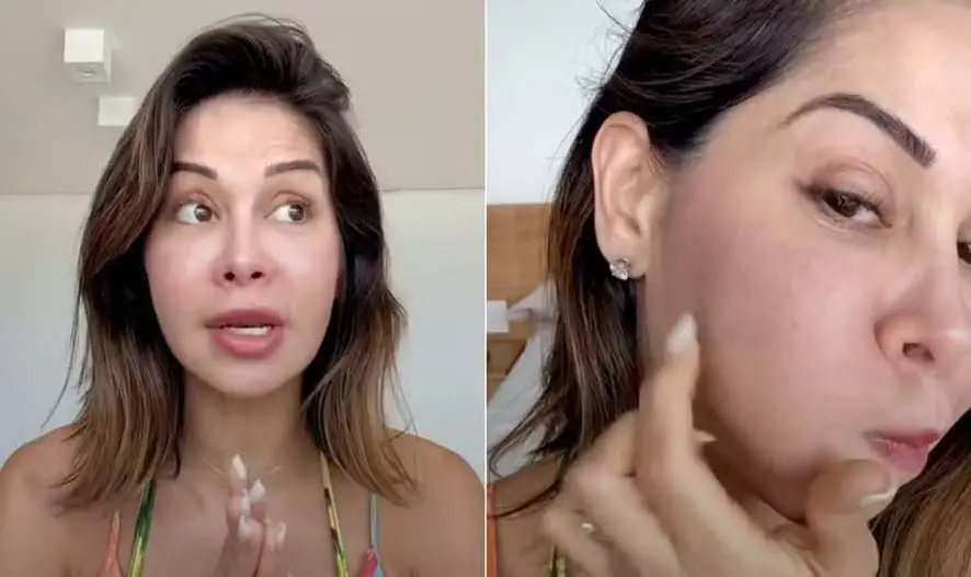 Imagem da notícia: O que é PMMA? Veja os riscos da substância que causou inchaço no rosto da influenciadora Maíra Cardi