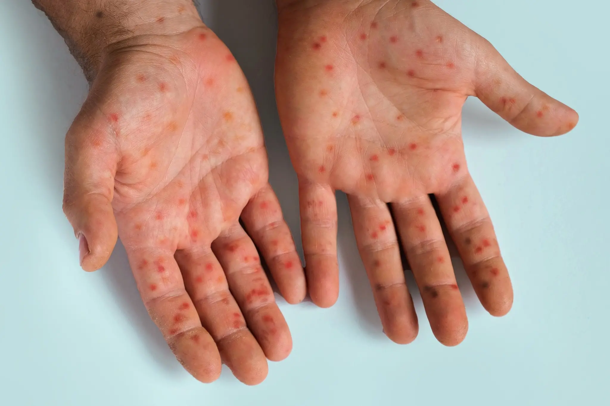 Imagem da notícia: Após primeiro caso de nova variante da mpox no Brasil, entenda o que é a doença e as formas de prevenção
