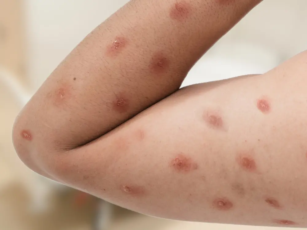 Imagem da notícia: Veja o que se sabe até o momento sobre a nova variante da Mpox identificada no Brasil