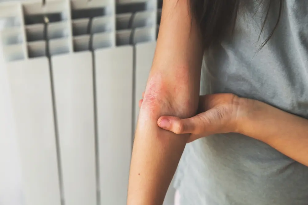 Imagem da notícia: Saiba como tratar dermatite atópica pelo SUS