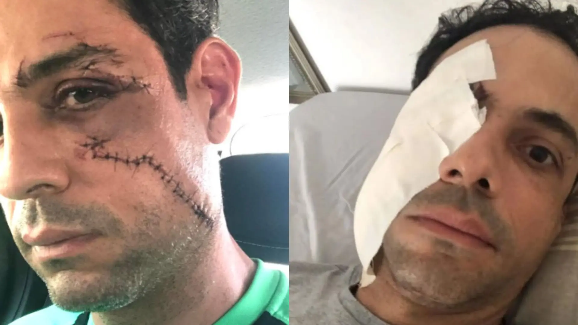 Imagem da notícia: Esposa de empresário que teve 62 pontos no rosto diz que por 'muito pouco' ele não perdeu a visão