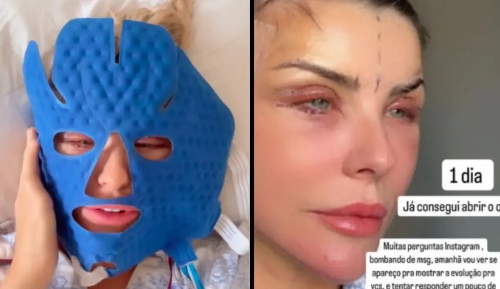 Imagem da notícia: Atriz Íris Stefanelli faz cirurgia para rejuvenescer rosto e mostra resultado: 'Nada de rugas'