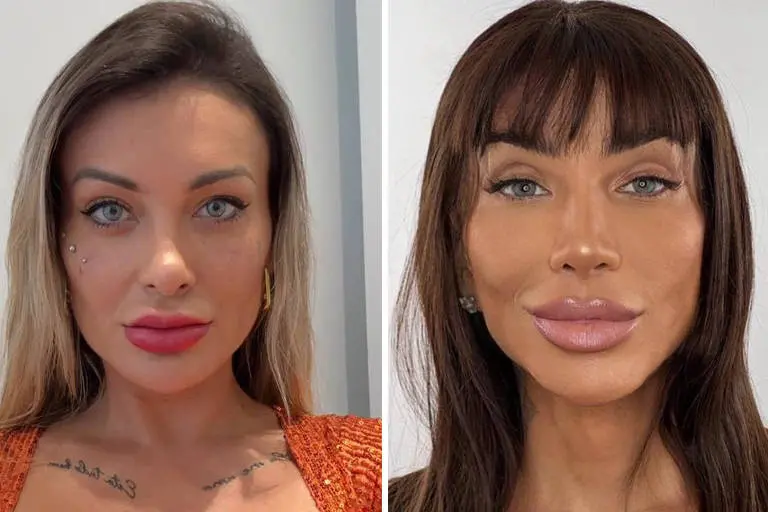 Imagem da notícia: Mudança de cor dos olhos: saiba por que procedimento feito em famosos é proibido no Brasil