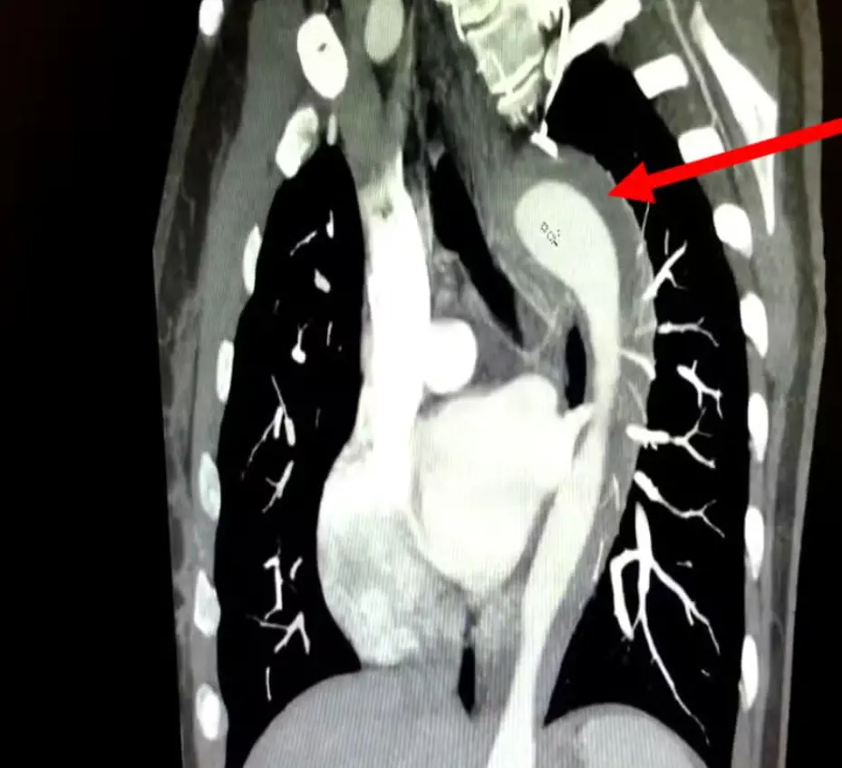 Imagem da notícia Mulher rompe aorta durante orgasmo e é levada à emergência em caso raro