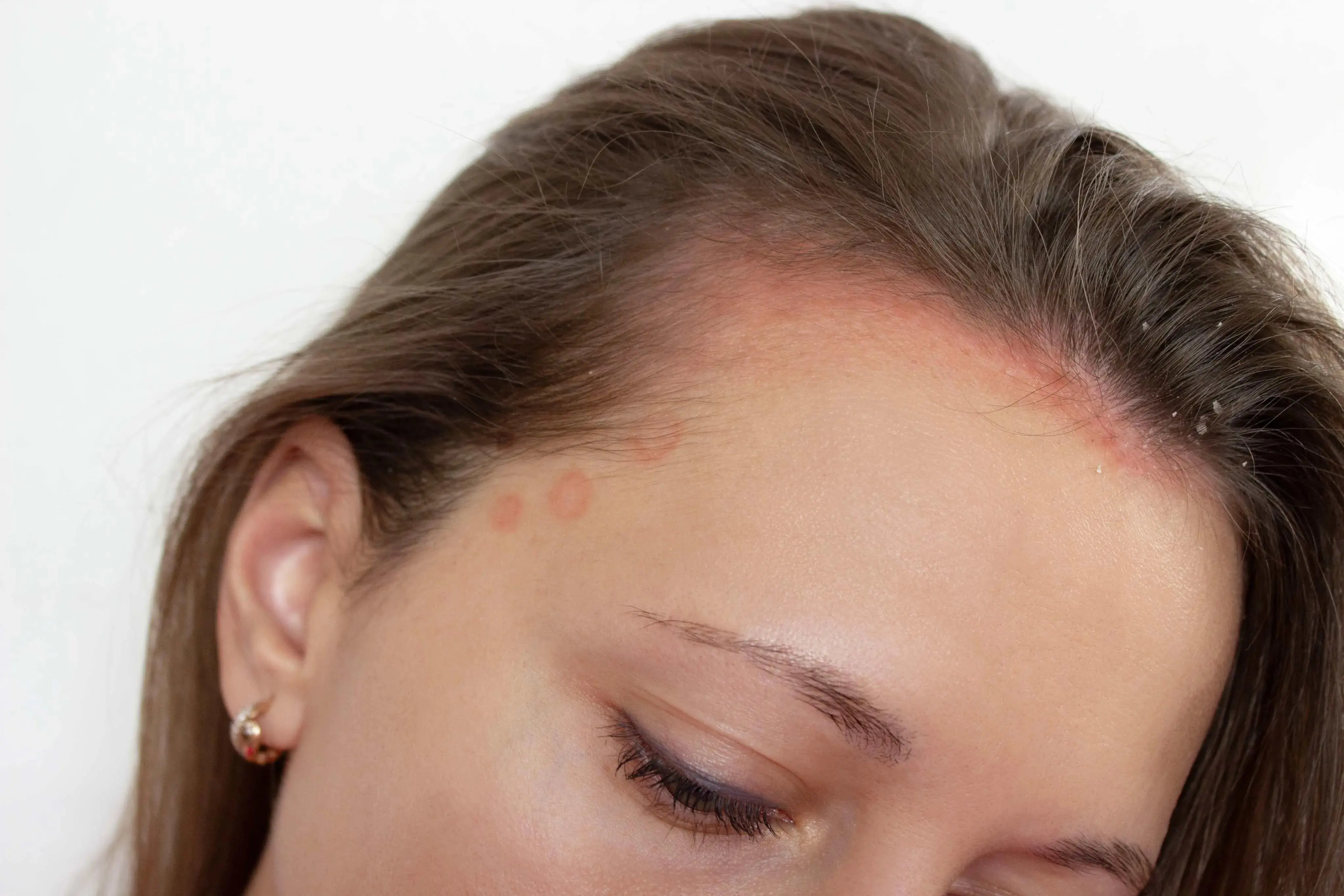 Imagem de cabeça com alergia, para matéria sobre Coceira na cabeça, o que pode ser?