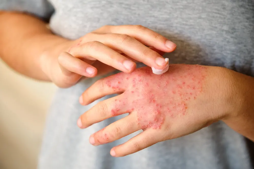 foto de pessoa com dermatite na mão passando pomada.