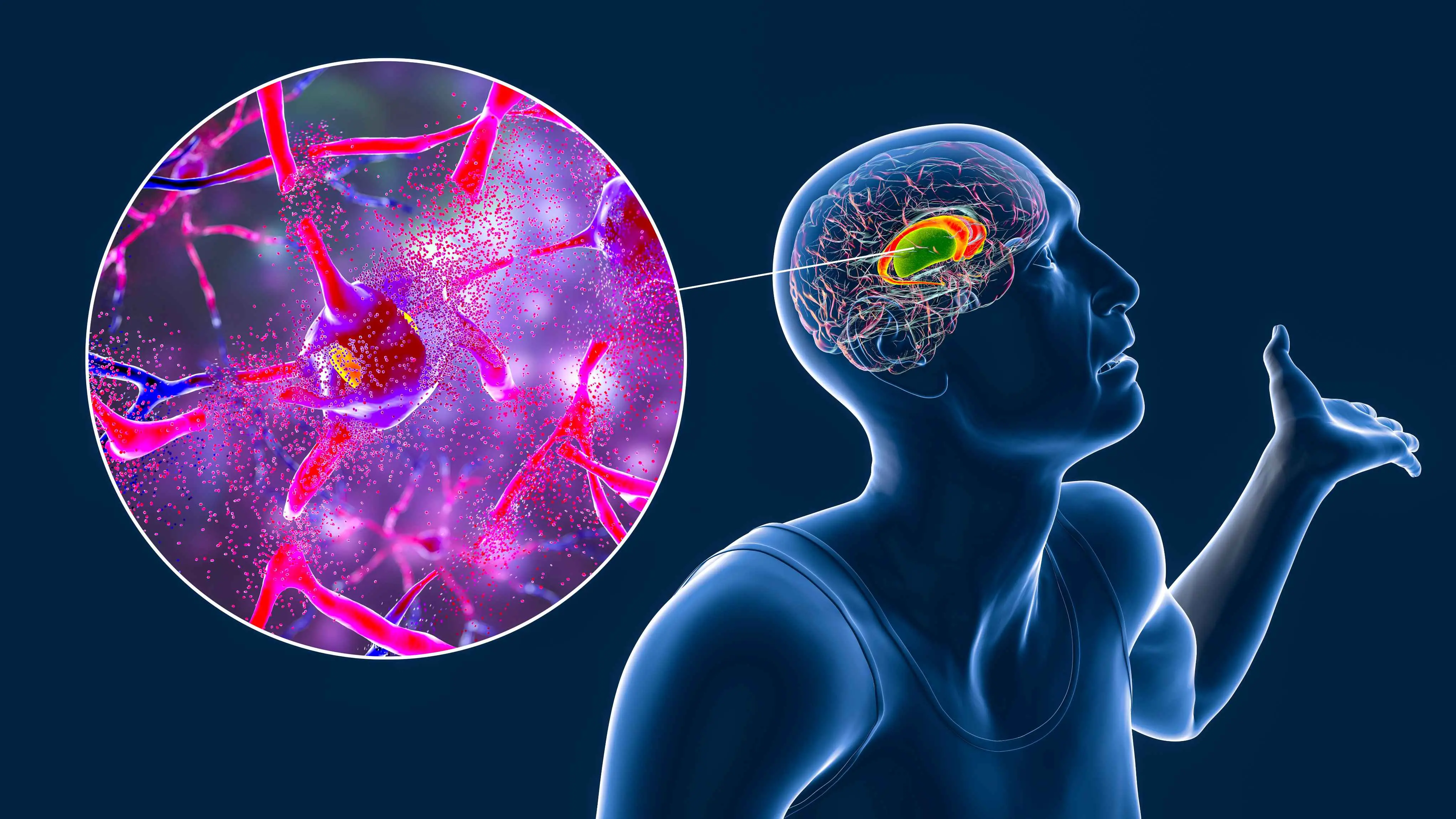 Imagem ilustrativa de um paciente de Doença de Huntington, com estriado dorsal, núcleo caudado e putâmen, destacados no cérebro de uma pessoa com doença de Huntington e visão em close da degradação neuronal, ilustração conceitual 3D