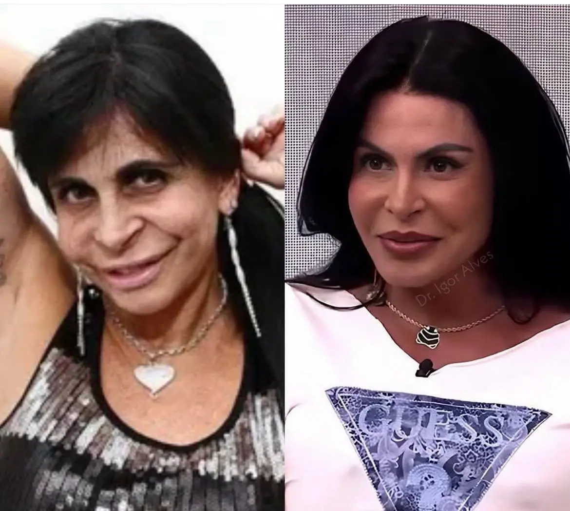 Imagem da notícia: Gretchen exibe transformação facial e elogia médico após novos procedimentos estéticos