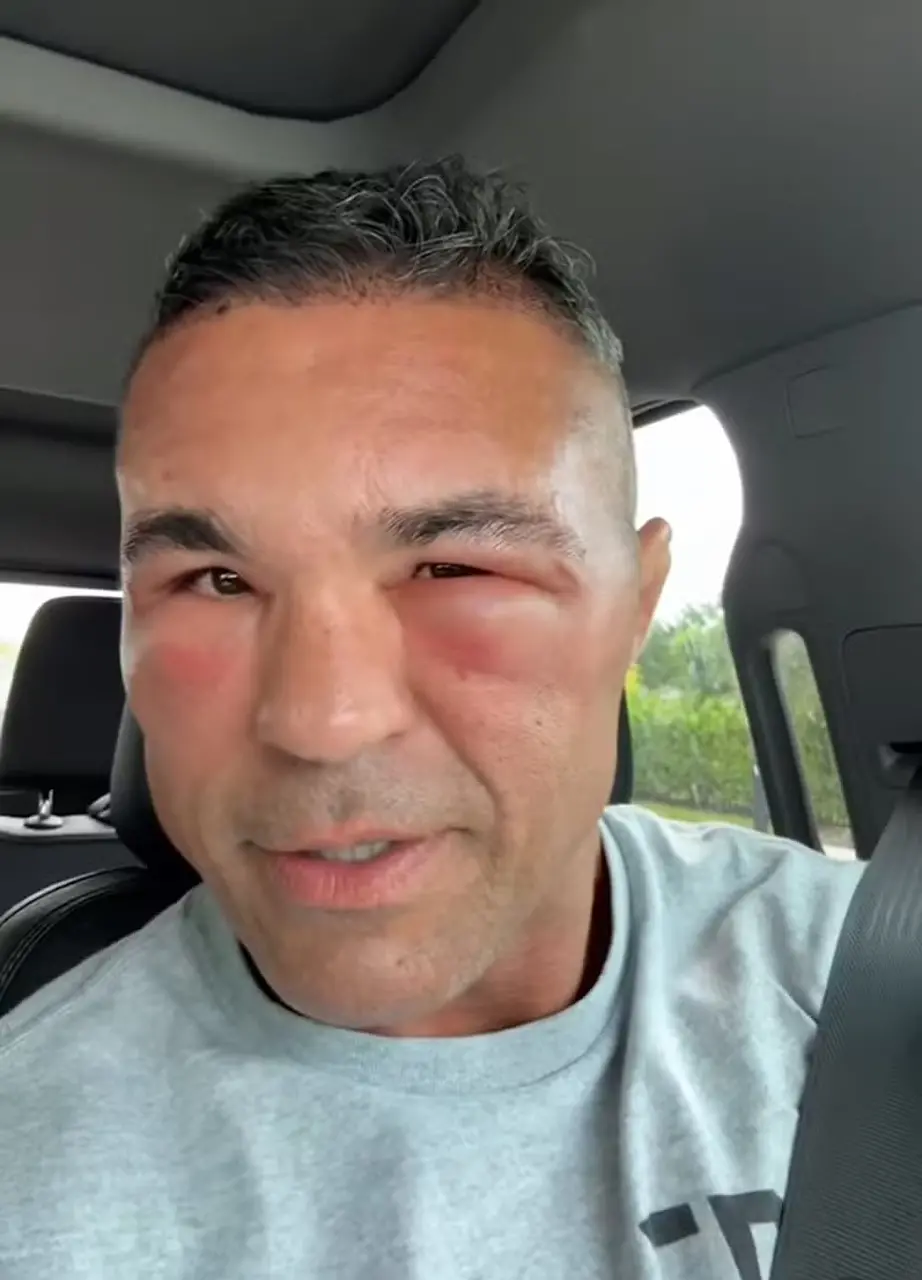 Imagem da notícia Vitor Belfort aparece com rosto inchado, mas explica: 'implante capilar'