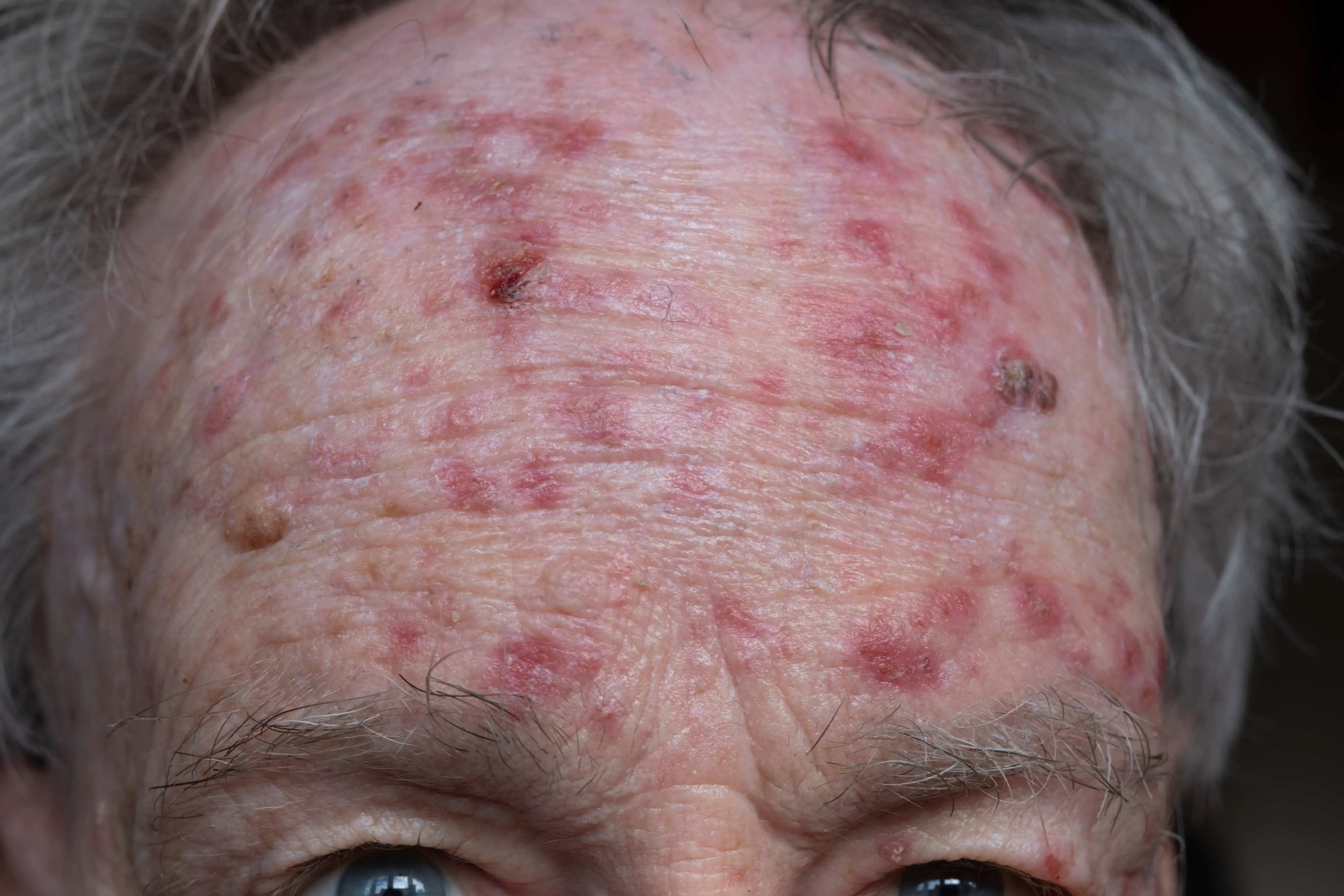 Imagem de um homem com câncer de pele na testa para matéria sobre queratose actínica: saiba os sinais, riscos e prevenção do câncer de pele.