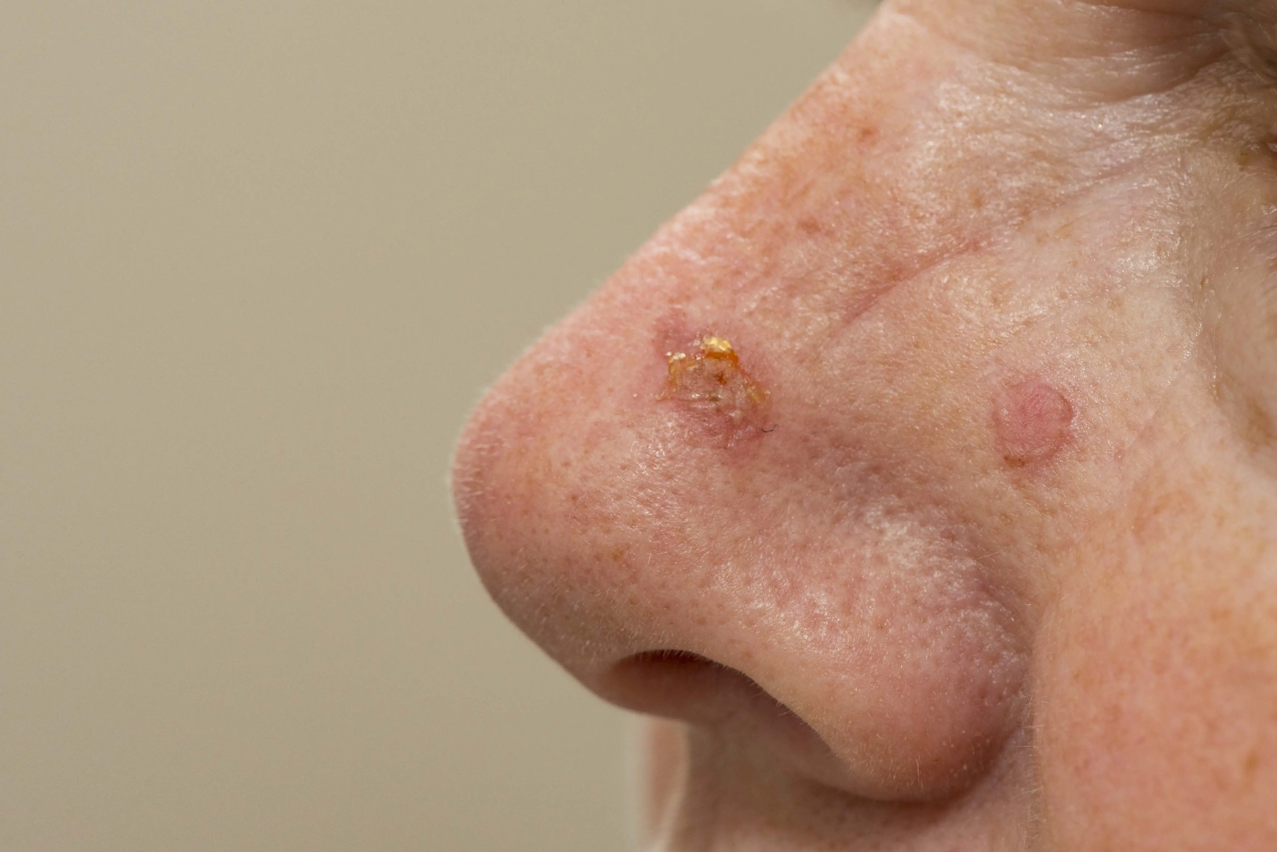 Imagem de um nariz com uma lesão para matéria sobre queratose actínica: saiba os sinais, riscos e prevenção do câncer de pele.