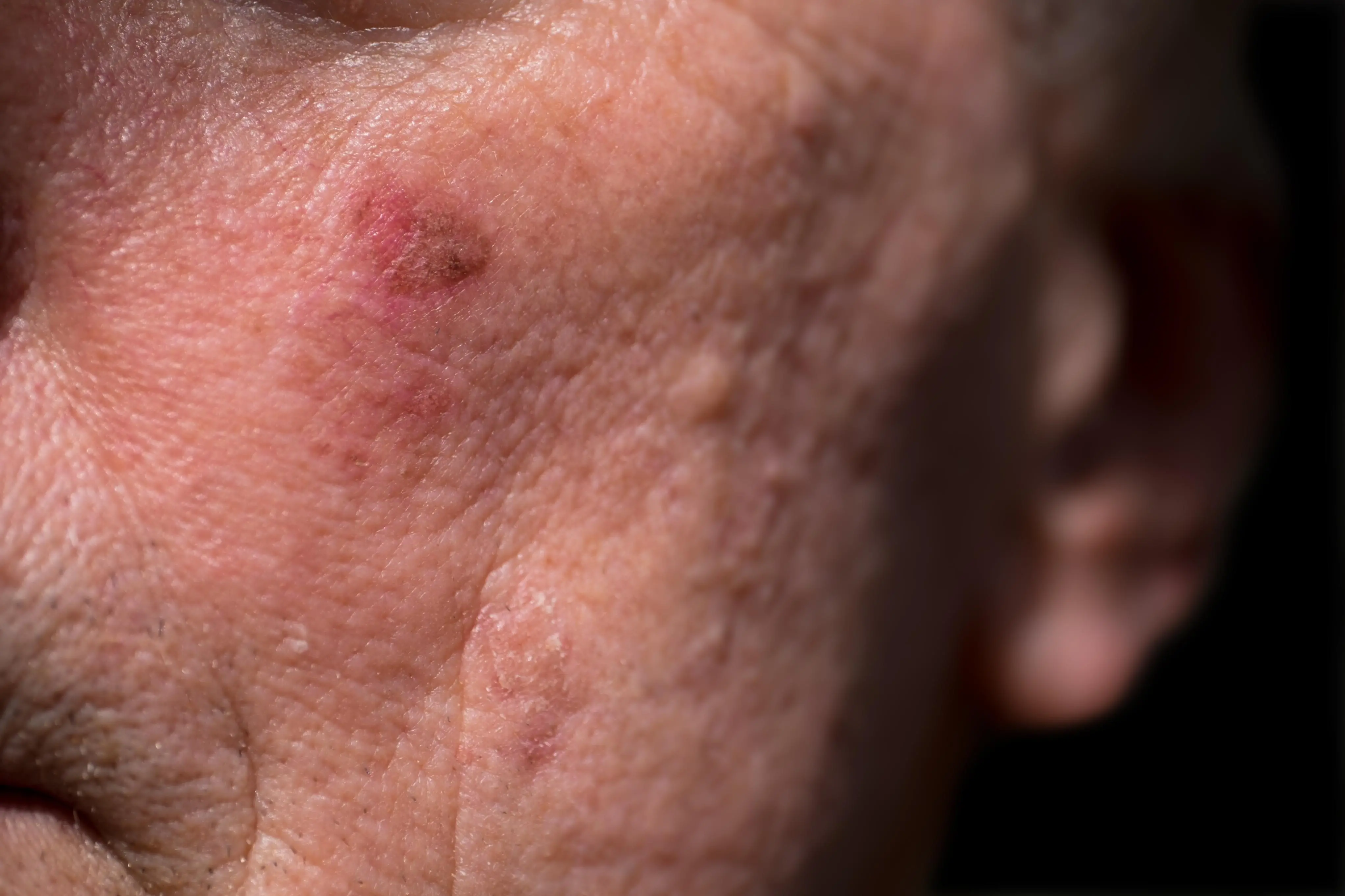 Imagem de uma lesão na bochecha para matéria sobre queratose actínica: saiba os sinais, riscos e prevenção do câncer de pele.