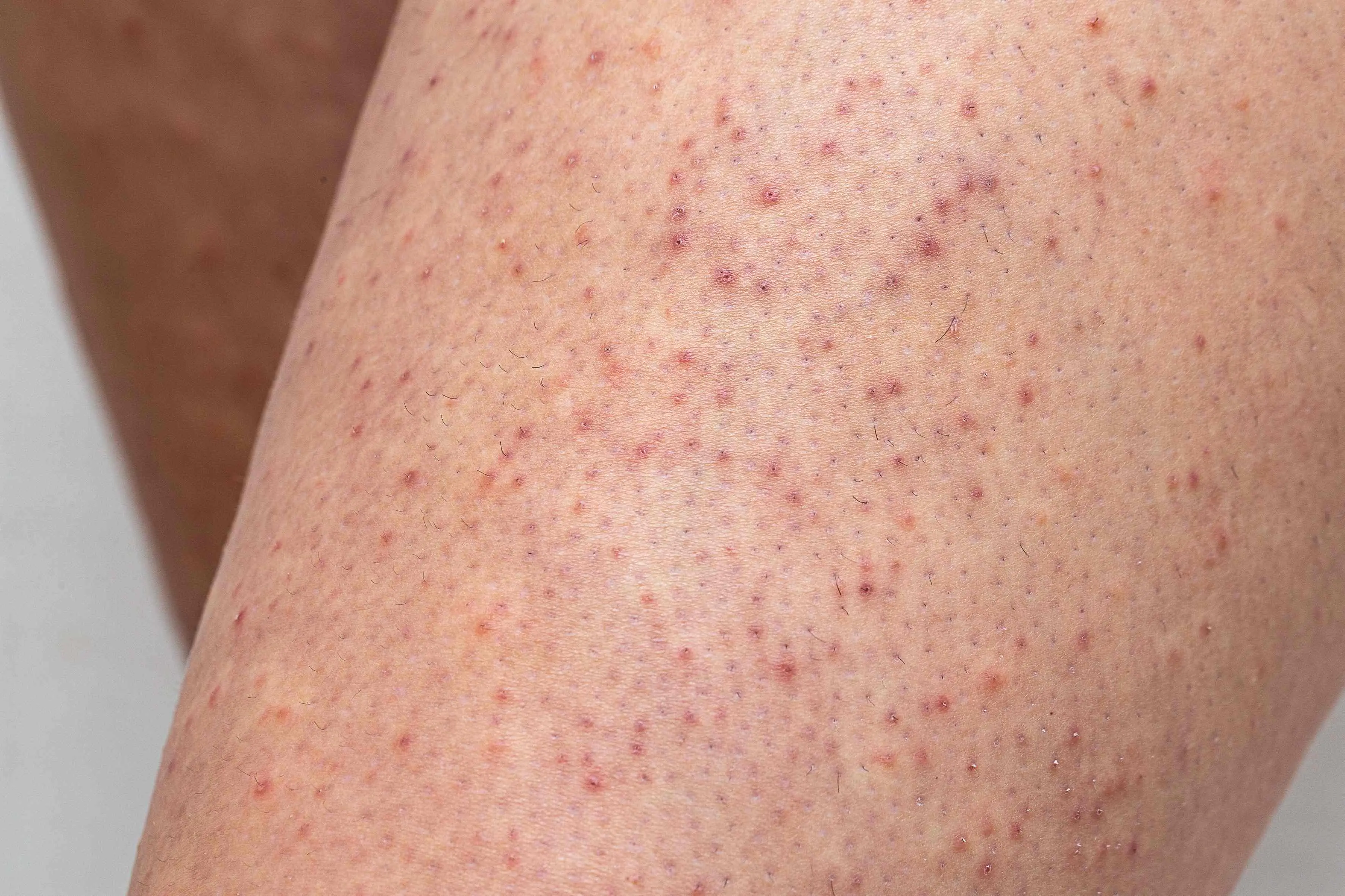 Imagem de uma pele com queratose pilar para matéria sobre queratose actínica: saiba os sinais, riscos e prevenção do câncer de pele.