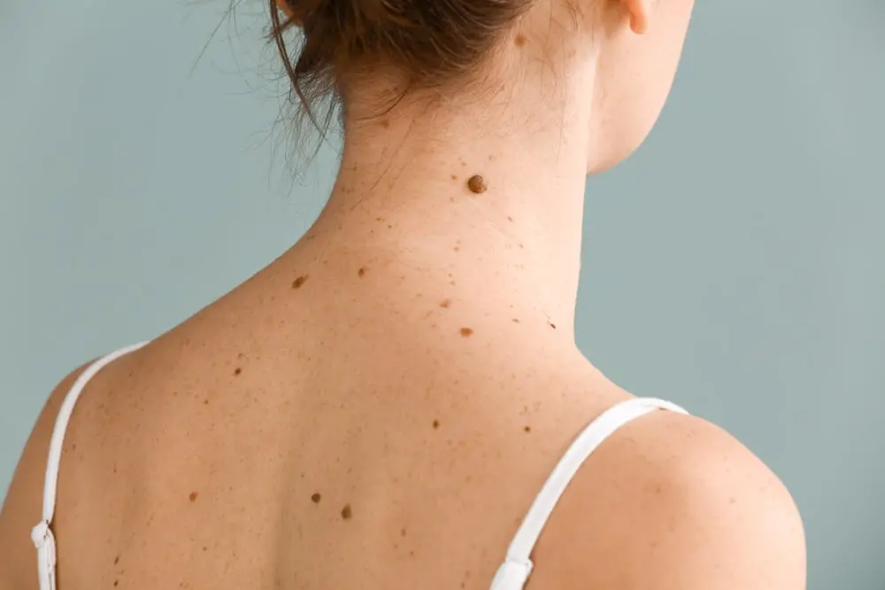 foto de mulher de costas mostrando pintas e sinais. Imagem para ilustrar matéria sobre melanoma e a regra do ABCDE de detecção precoce.